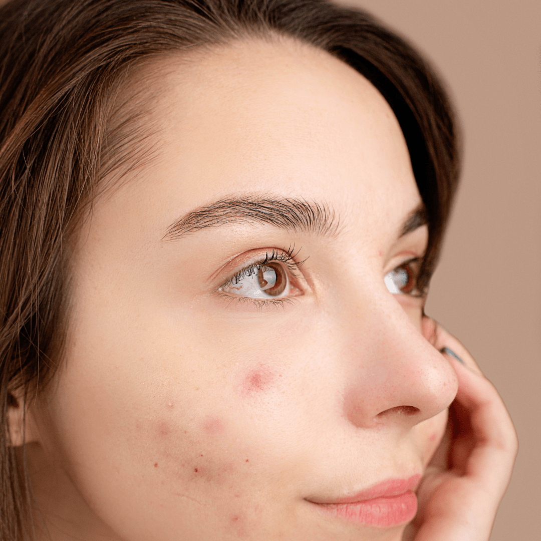 Oily, Combination, & Acne-Prone Skin - Sapónne Naturals