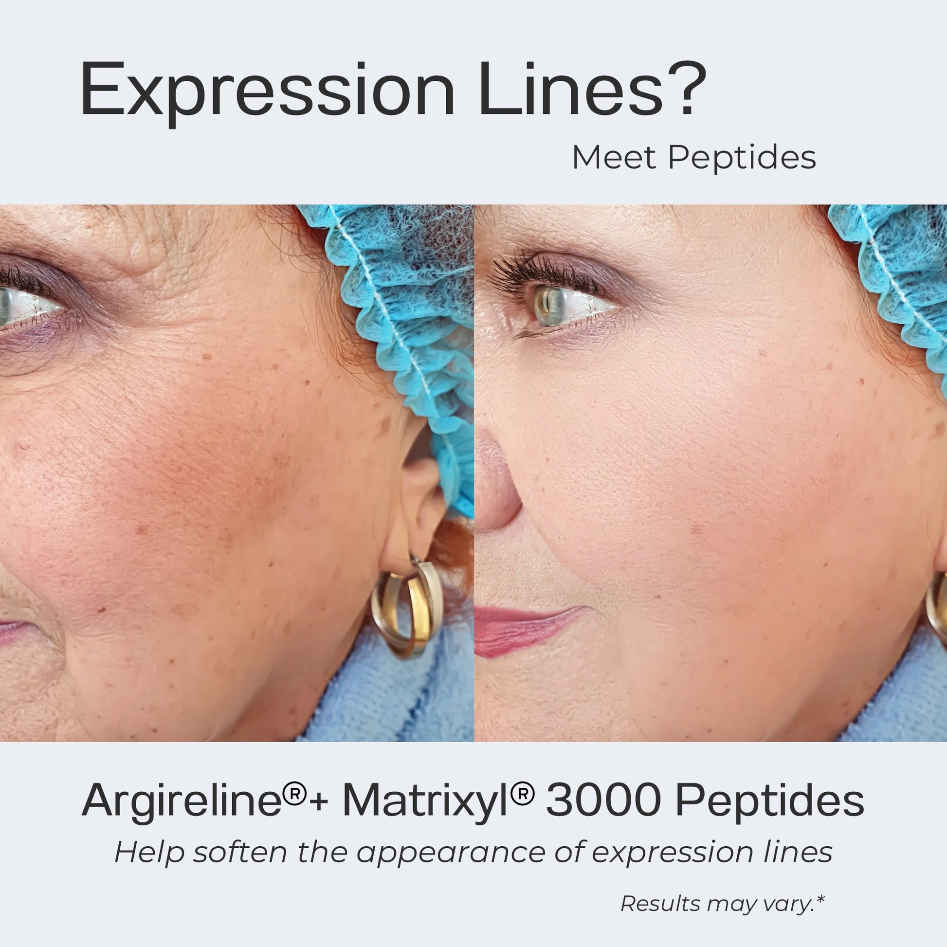 Advertisement for Argireline and Matrixyl 3000 Peptides showing a before and after effect on expression lines.